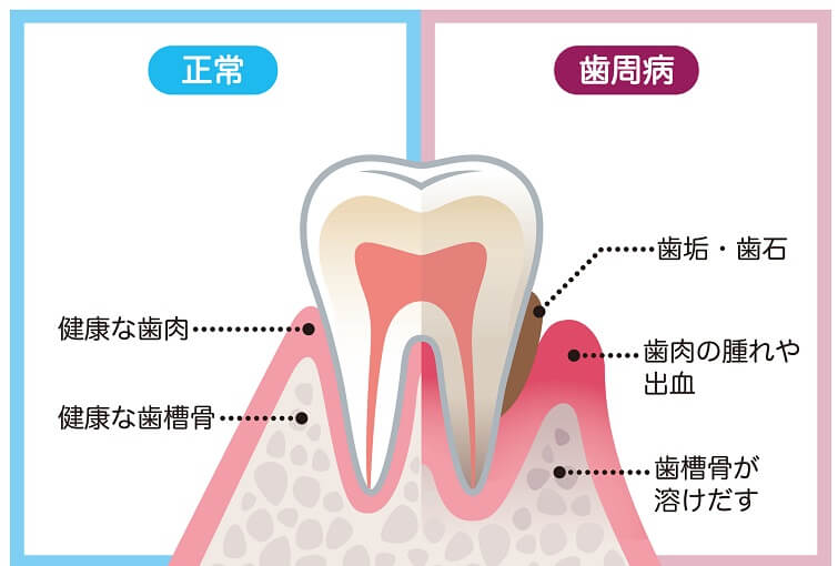 歯周病の原因は？