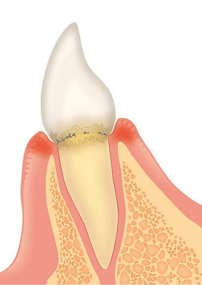 歯肉炎